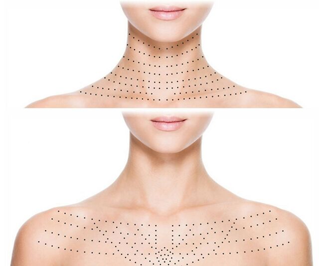 Marca en la piel del cuello y escote para rejuvenecer la biorevitalización. 