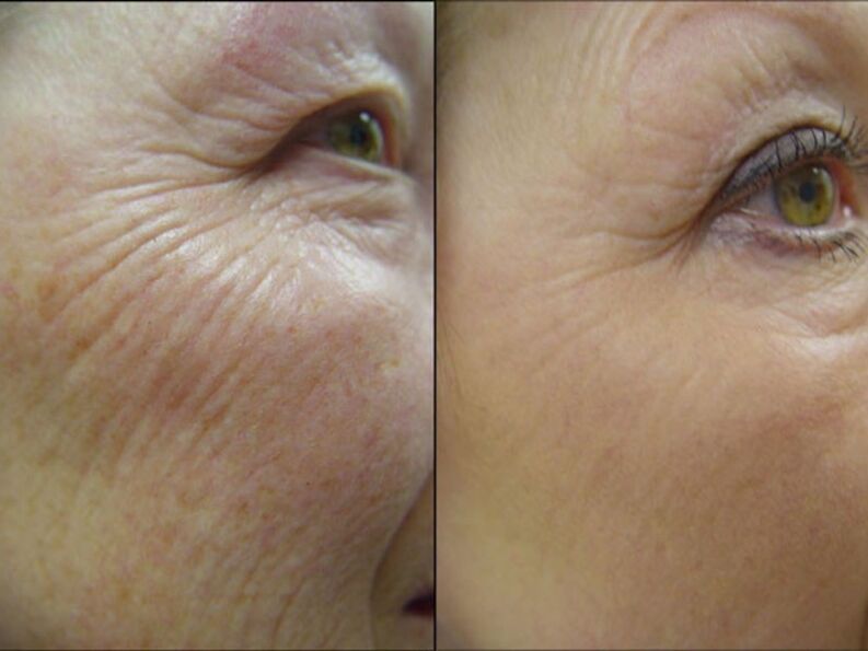 Antes y después del procedimiento de rejuvenecimiento con láser reducción significativa de las arrugas